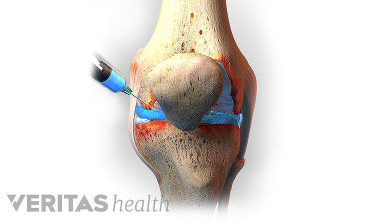 Illustration of a knee injection