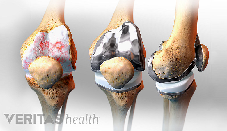 illustration showing the steps of a knee replacement surgery