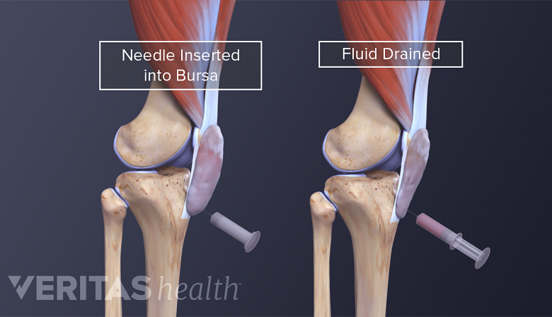 Drainage of the knee bursa using needle aspiration.
