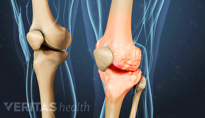 Illustration of Osteoarthritis in a knee joint