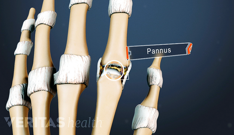 Hand anatomy highlighting pannus