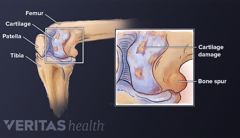 Illustration showing knee joint inflammation and a inset showing bone spur and cartilae damage.